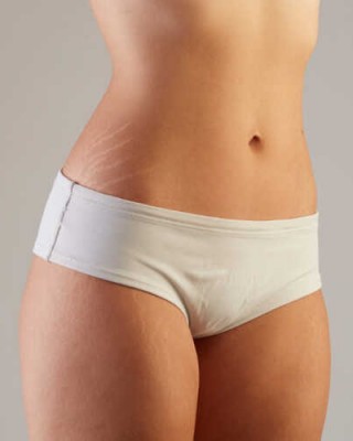 Stretch Marks Remover Oil, Skin White Stretch Marks after Pregnancy, Weight Loss, and breastfeeding, Crack Remover of Body Oil, 125ml